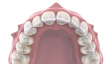 Невеликі множинні порушення положення зубів