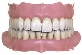 Екструзований зуб