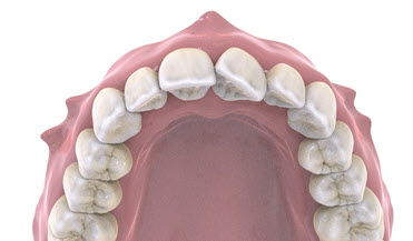 Ротований зуб